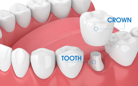 Dental Crowns